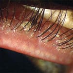 mascara mites maple grove eye doctors