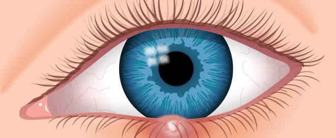 eye infection, stye, eye doctor, eye exam