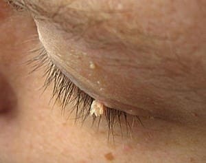 eyelid skin tag, treatment to remove eyelid skintag