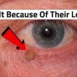 skin tag on eyelid Maple grove eye doctors at pearle vision