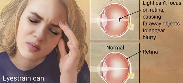 Myopia and digital eye strain Maple Grove