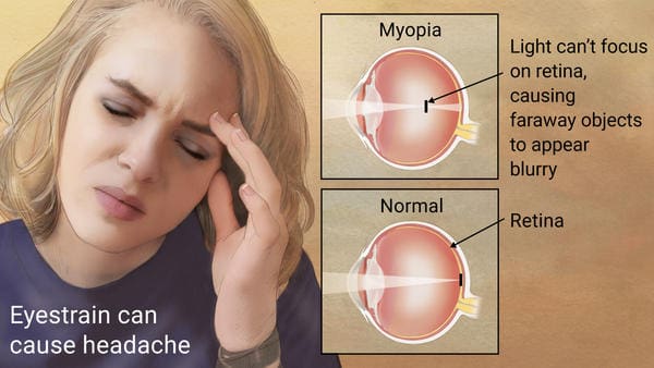 Myopia and digital eye strain Maple Grove