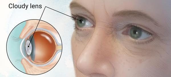 Symptoms of cataracts Maple Grove