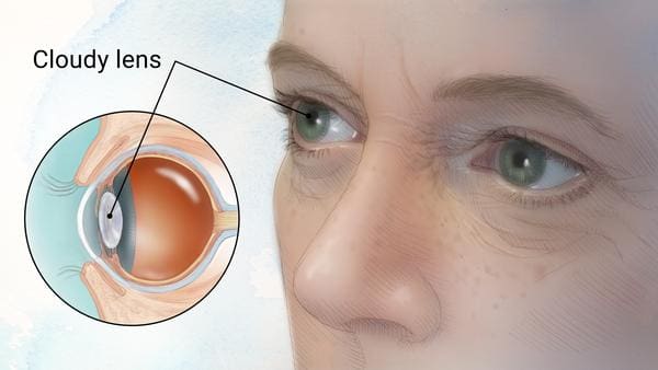 Symptoms of cataracts Maple Grove
