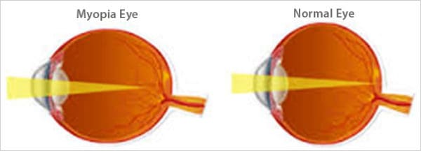 Myopia Control Program - Maple Grove Eye Doctors 