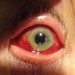 Bleeding Eyes Maple Grove Eye Doctors at Pearle Vision