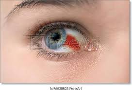 Burst Blood vessel in eye Maple Grove Eye Doctors at Pearle Vision