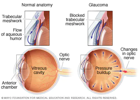 Glaucoma Graphic Maple Grove Eye Doctors at Pearle Vision