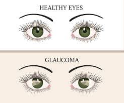 Glaucoma eyes vx healthy eyes Maple Grove Eye Doctors at Pearle Vision