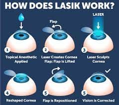 Lasik surgery Maple Grove Eye Doctors at Pearle Vision